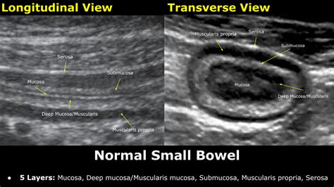 measurement of small intestine thickness|Ultrasound Imaging of Bowel Pathology: Technique .